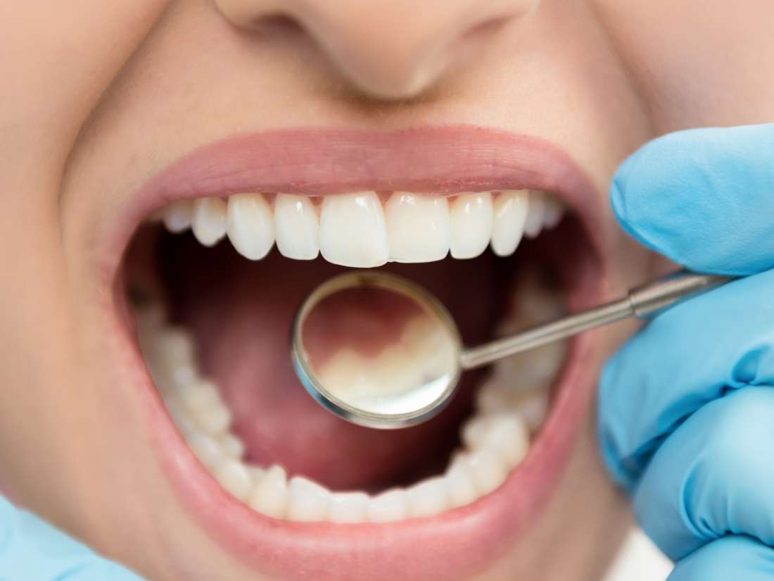 fluoride treatment